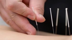 Acupuncture for Chemotherapy